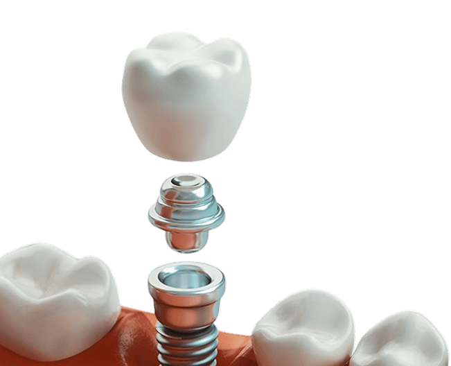 Итого за готовый зуб