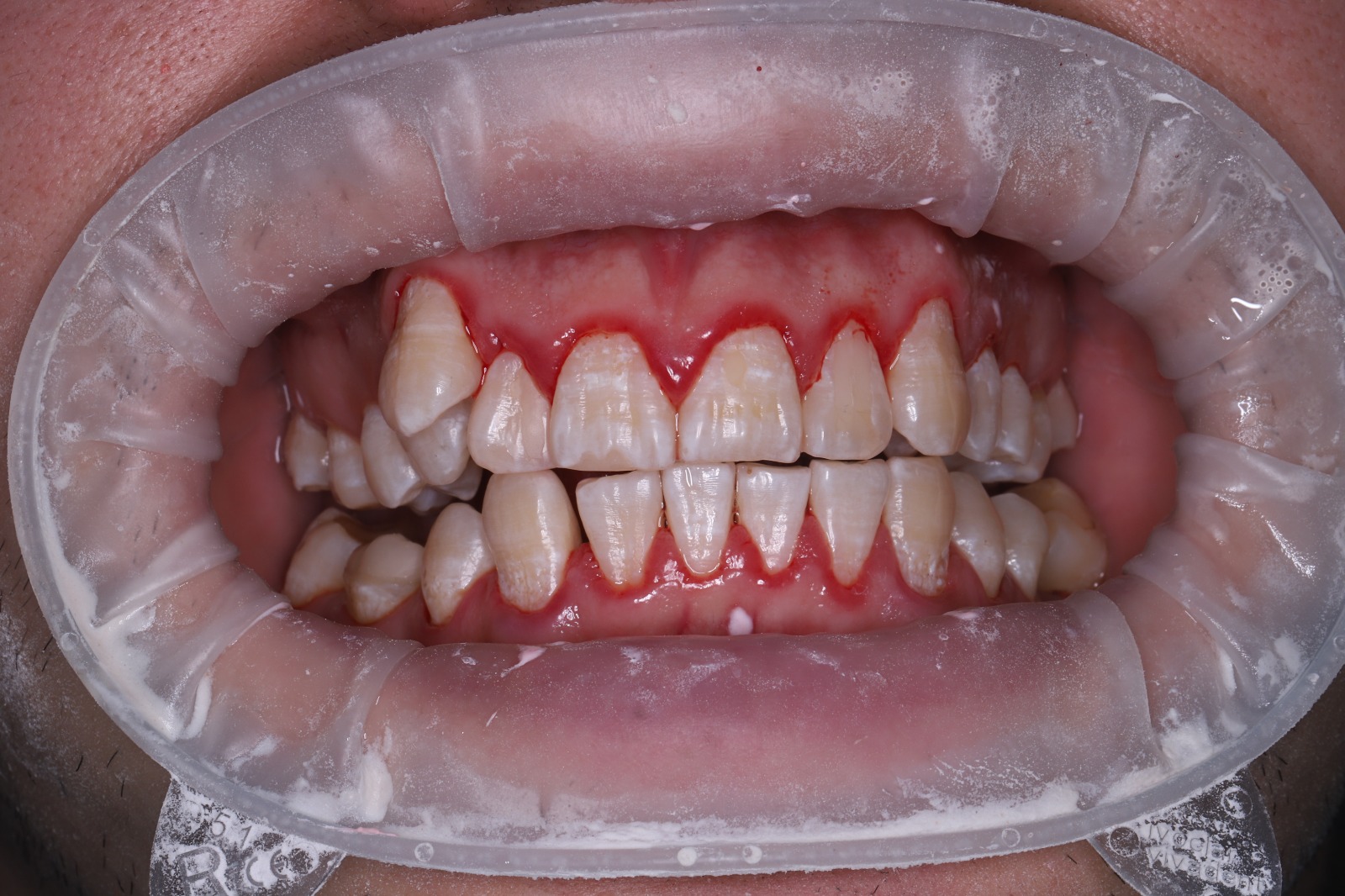 Лечение гингивита