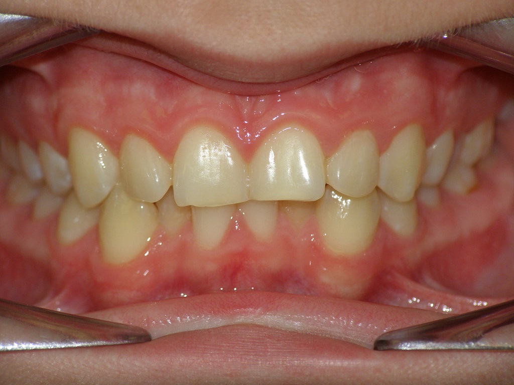 Исправление прикуса