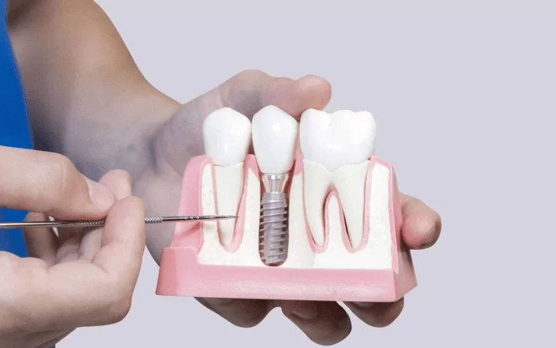 Мост или имплант - что лучше?