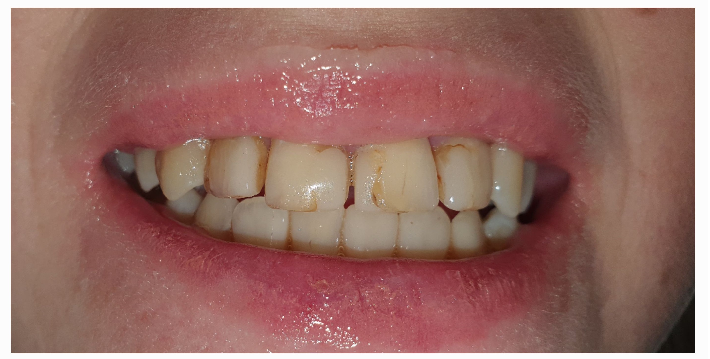 Композитные виниры