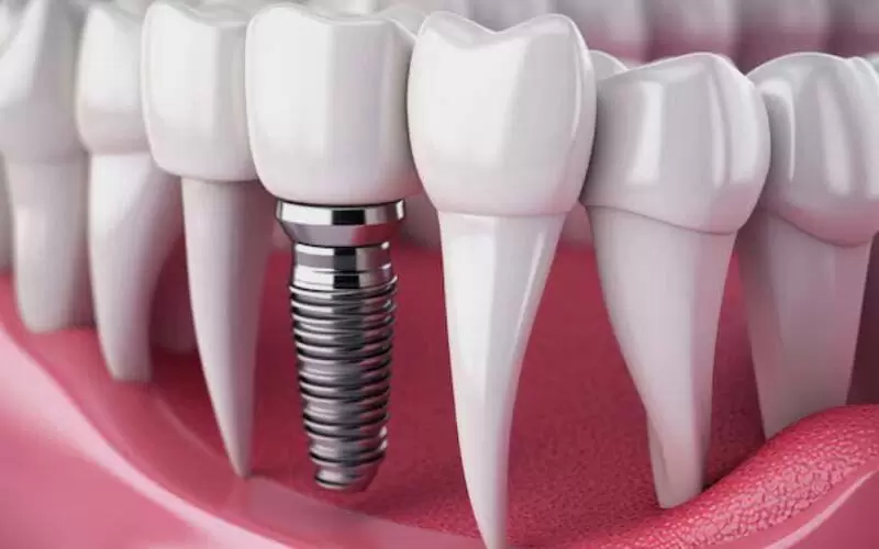 Сколько длится приживление зубных имплантов