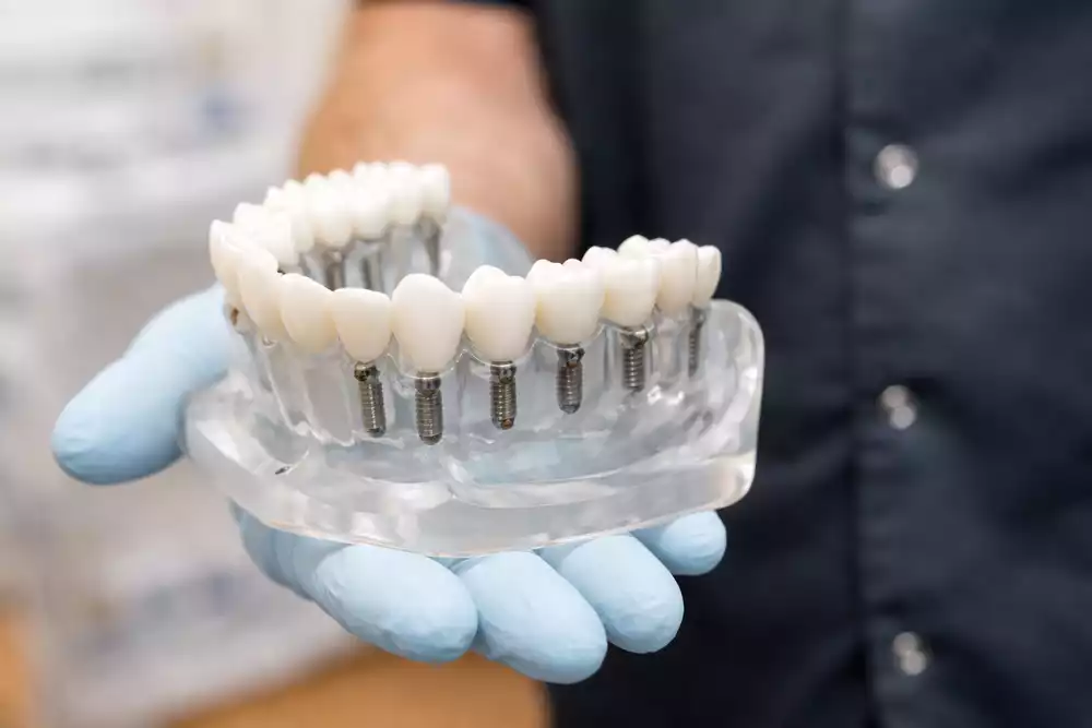 Замена всех зубов на импланты: методы, этапы и варианты протезирования