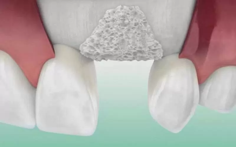 Как наращивают костную ткань для имплантации зуба