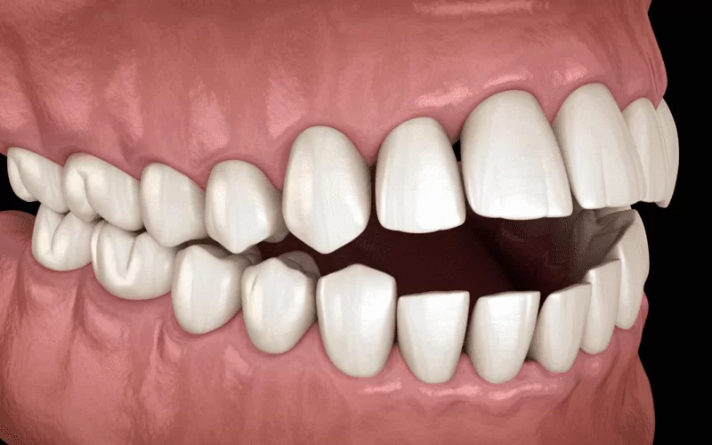 Открытый прикус: как исправить у взрослого и ребенка