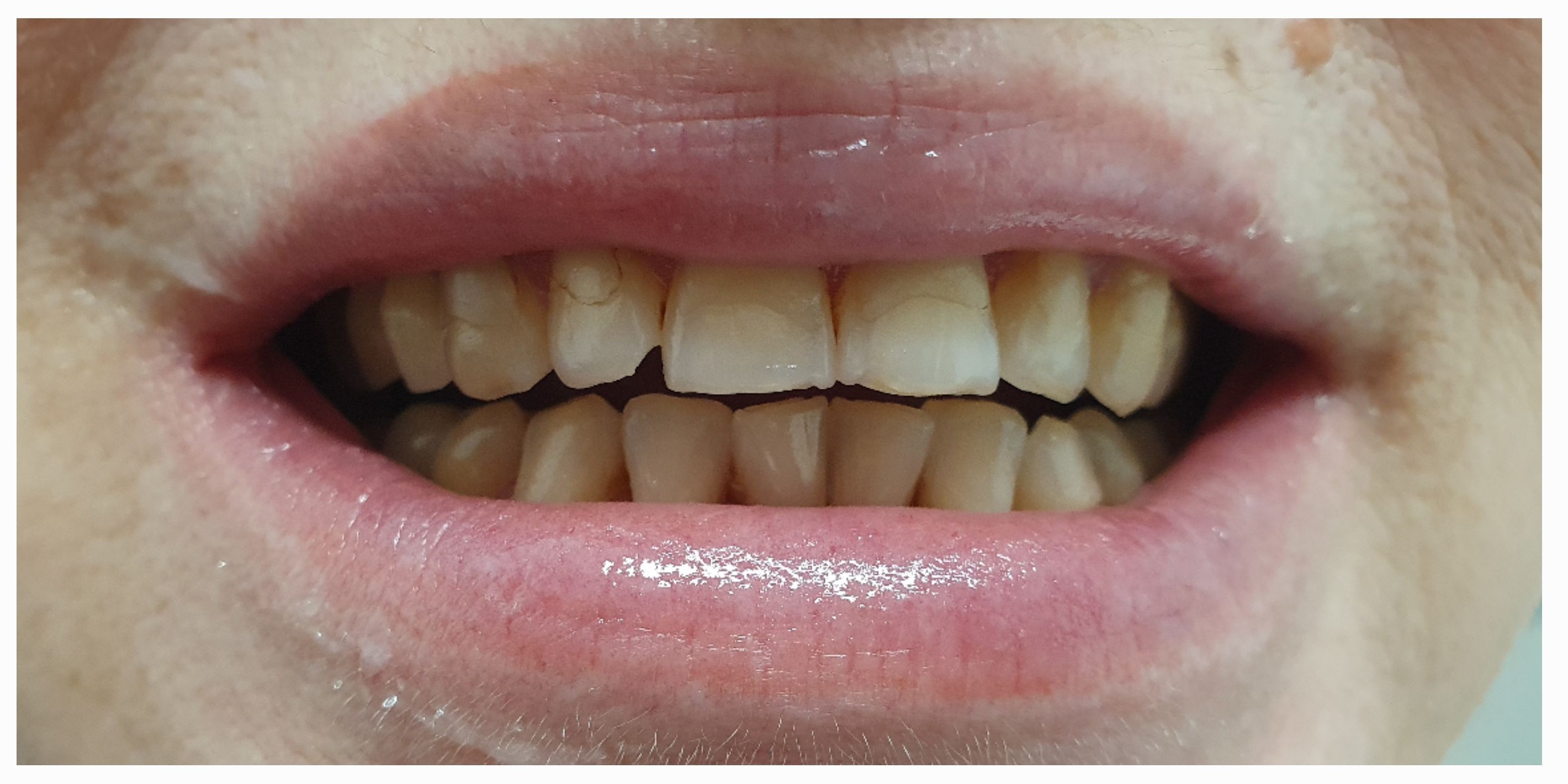 Композитные виниры