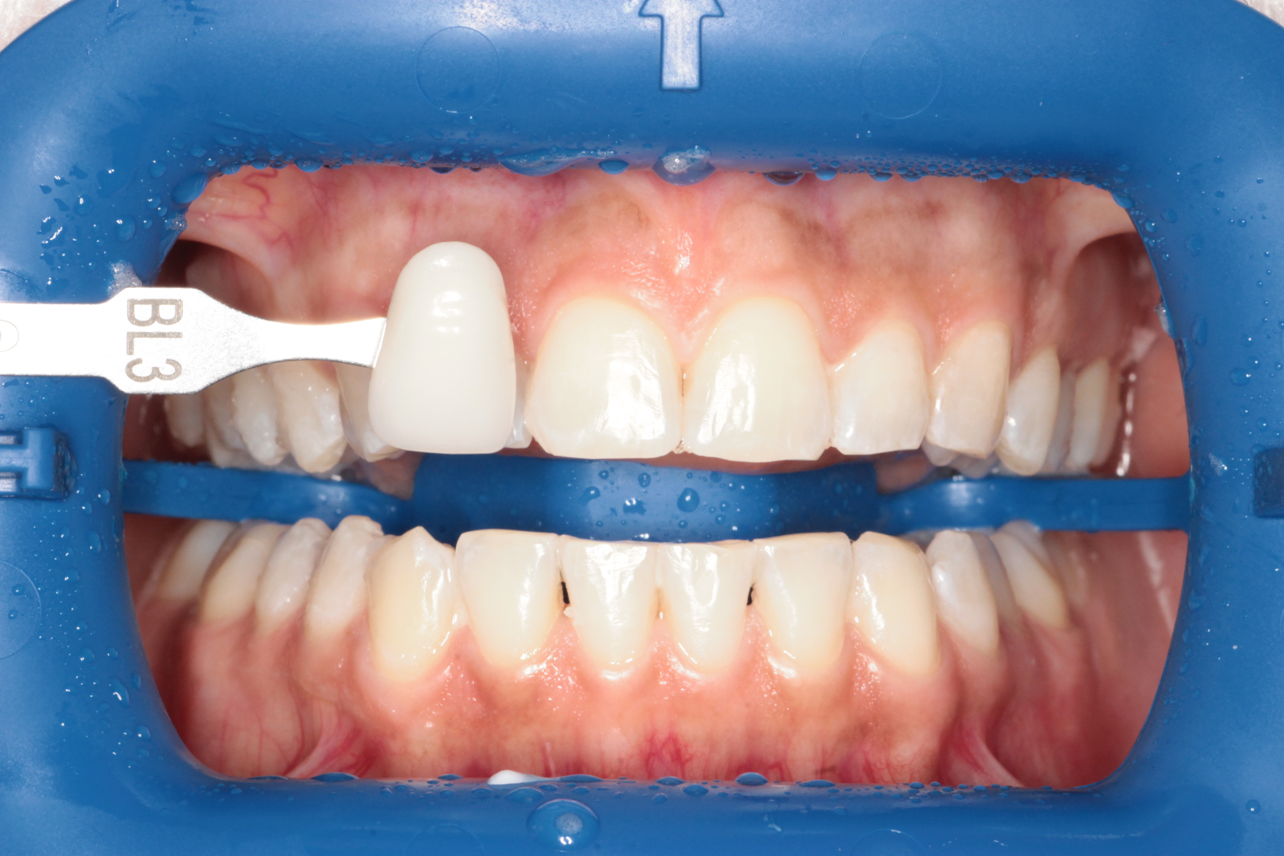 Отбеливание