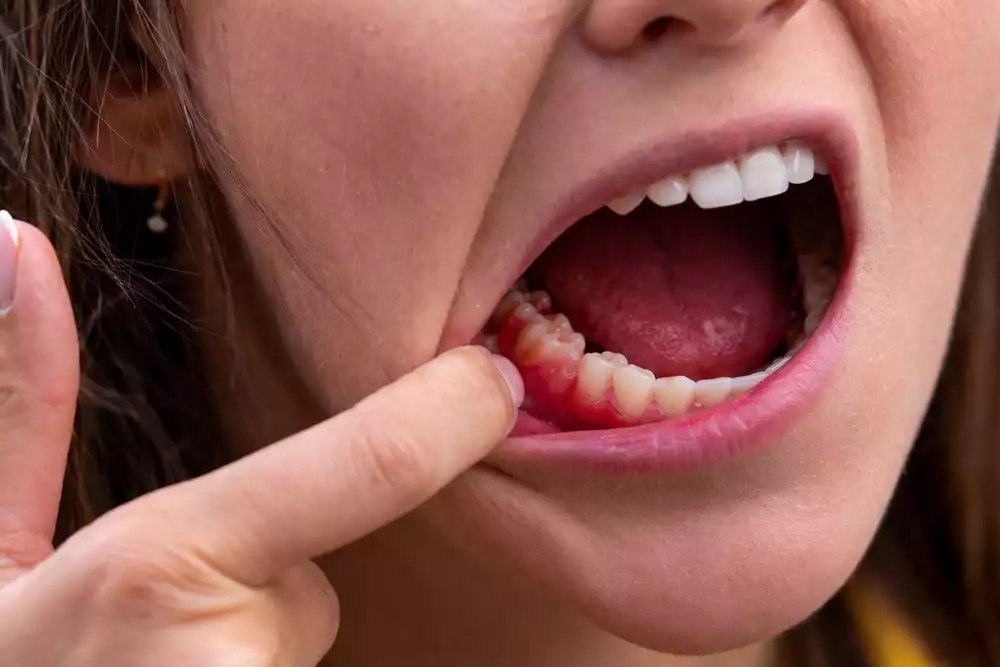 Гной после удаления зуба: что делать и когда это опасно