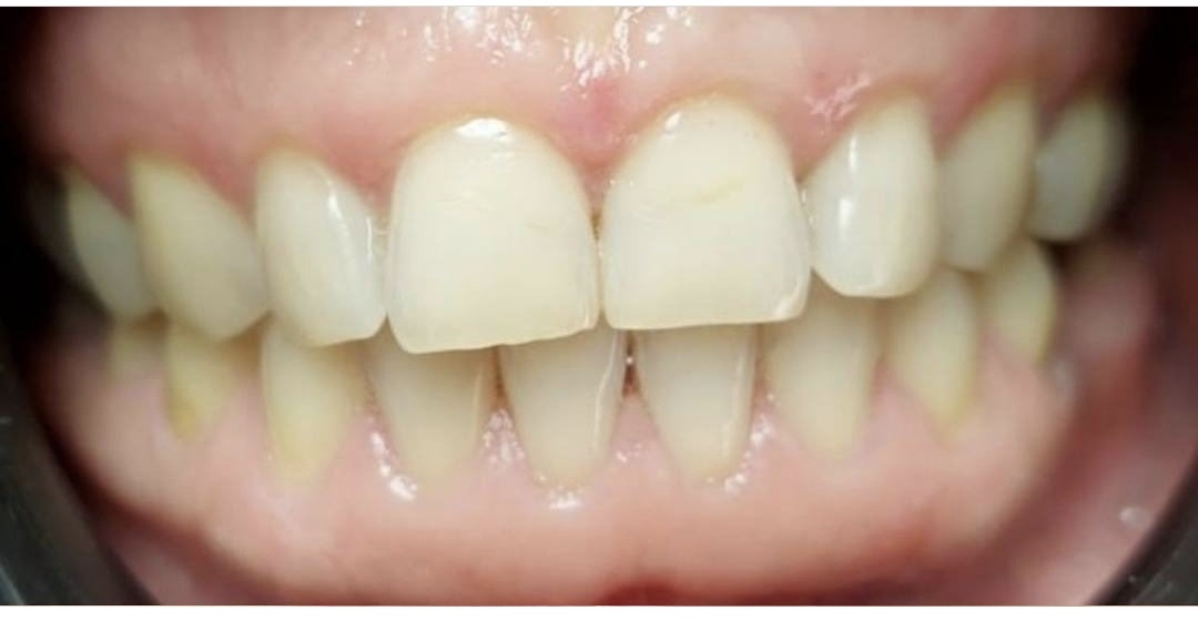 Композитные виниры