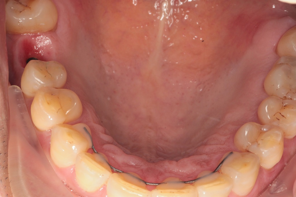 Установка имплантата