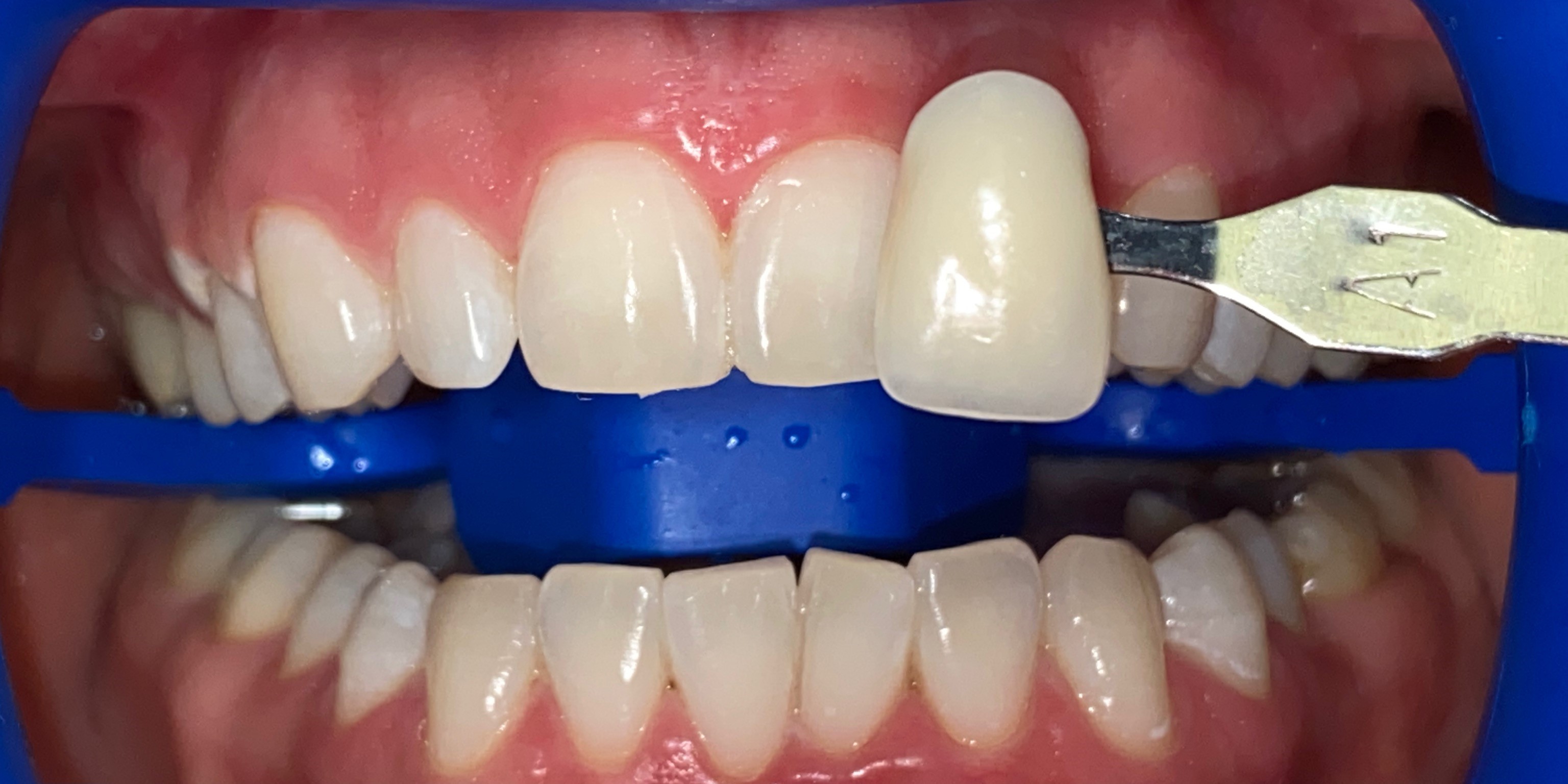 Отбеливание