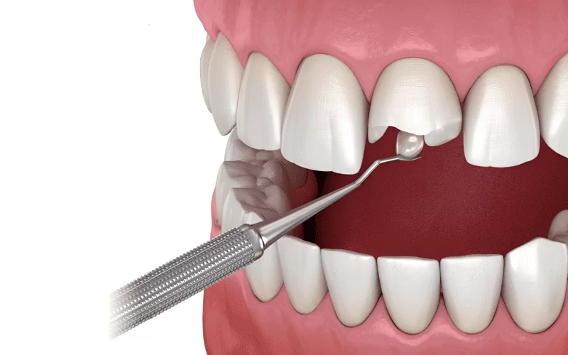 Откололся зуб: что делать и как восстановить повреждение?