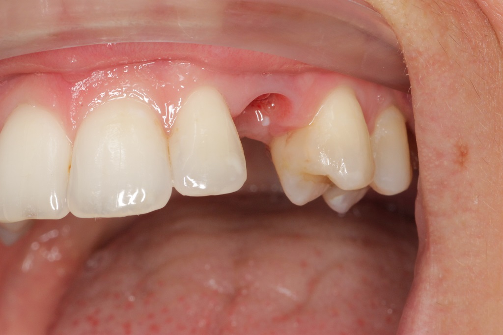 Установка имплантата