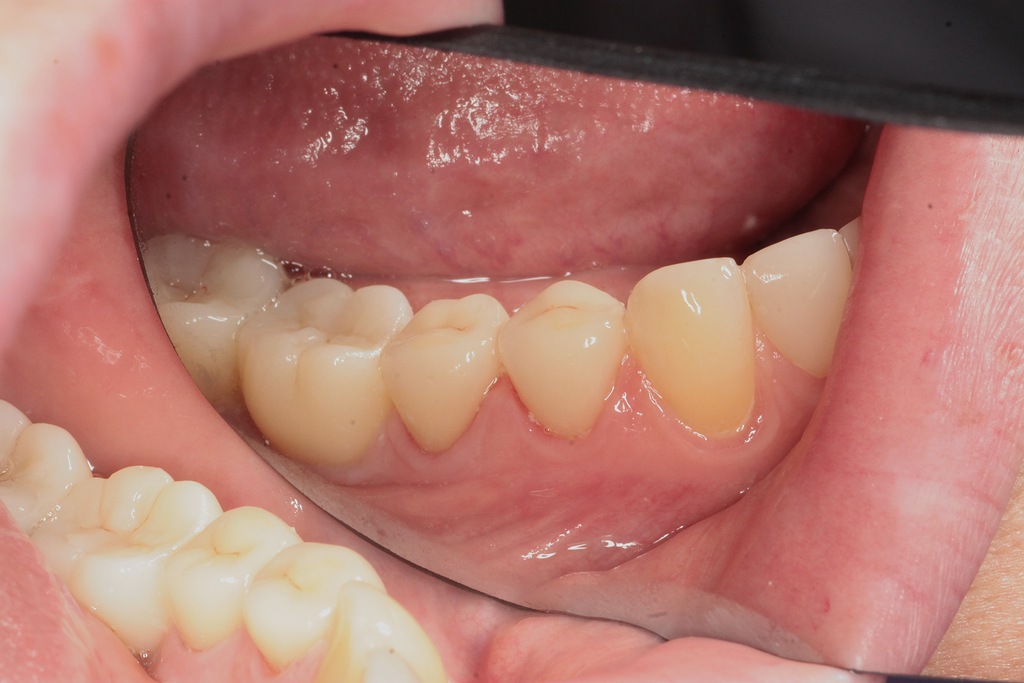 Коронки из диоксид циркония