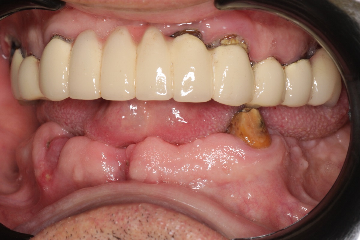 Восстановление верхней и нижней челюсти по системе All-on-6