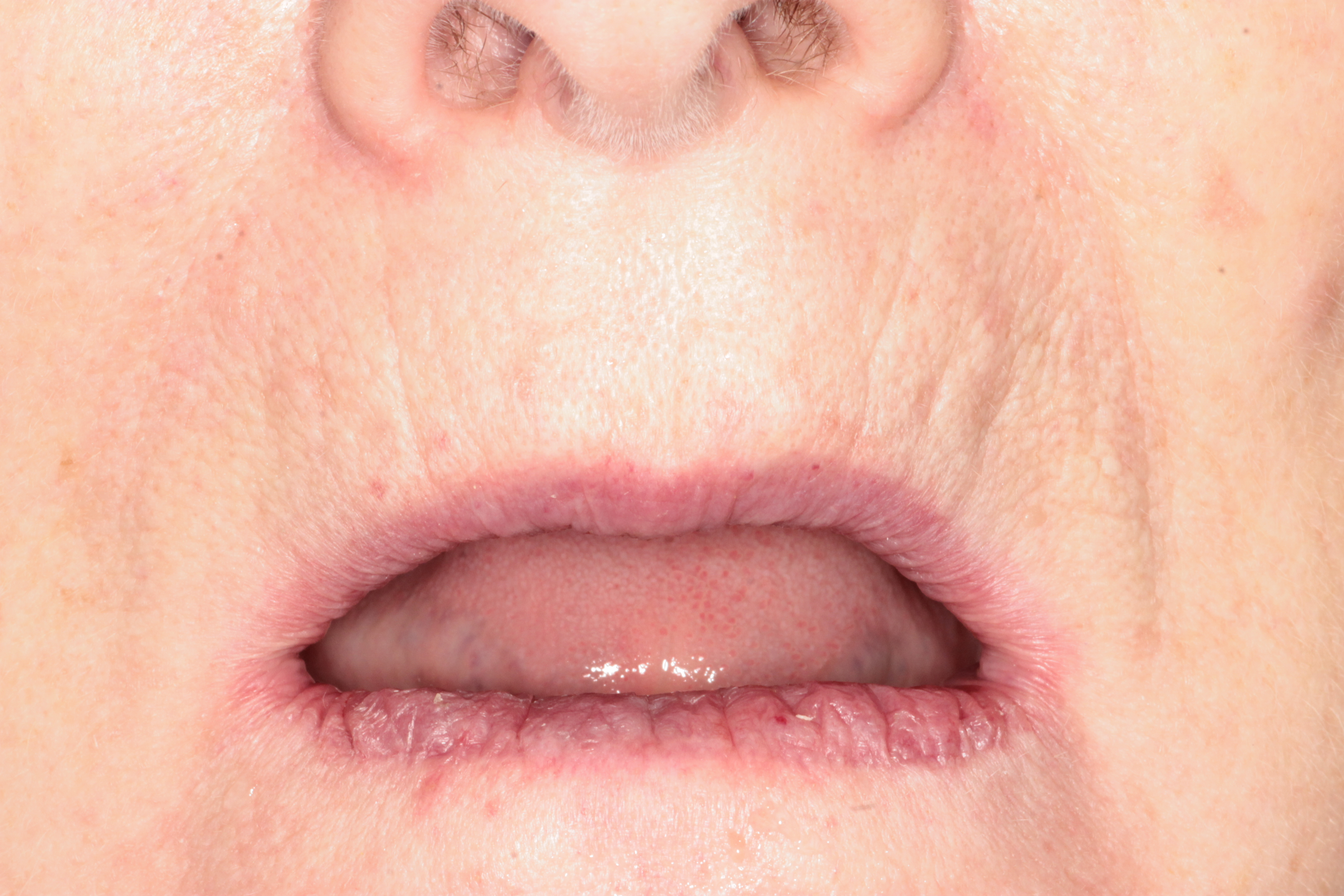 Восстановление зубов ALL-ON-6