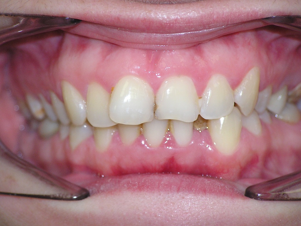 Исправление прикуса