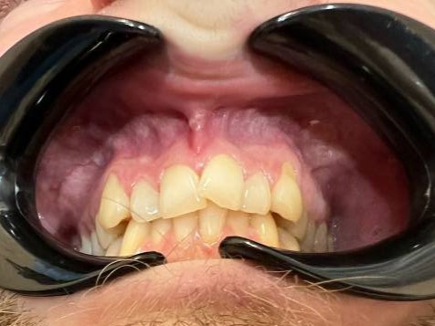 Исправление прикуса брекетами