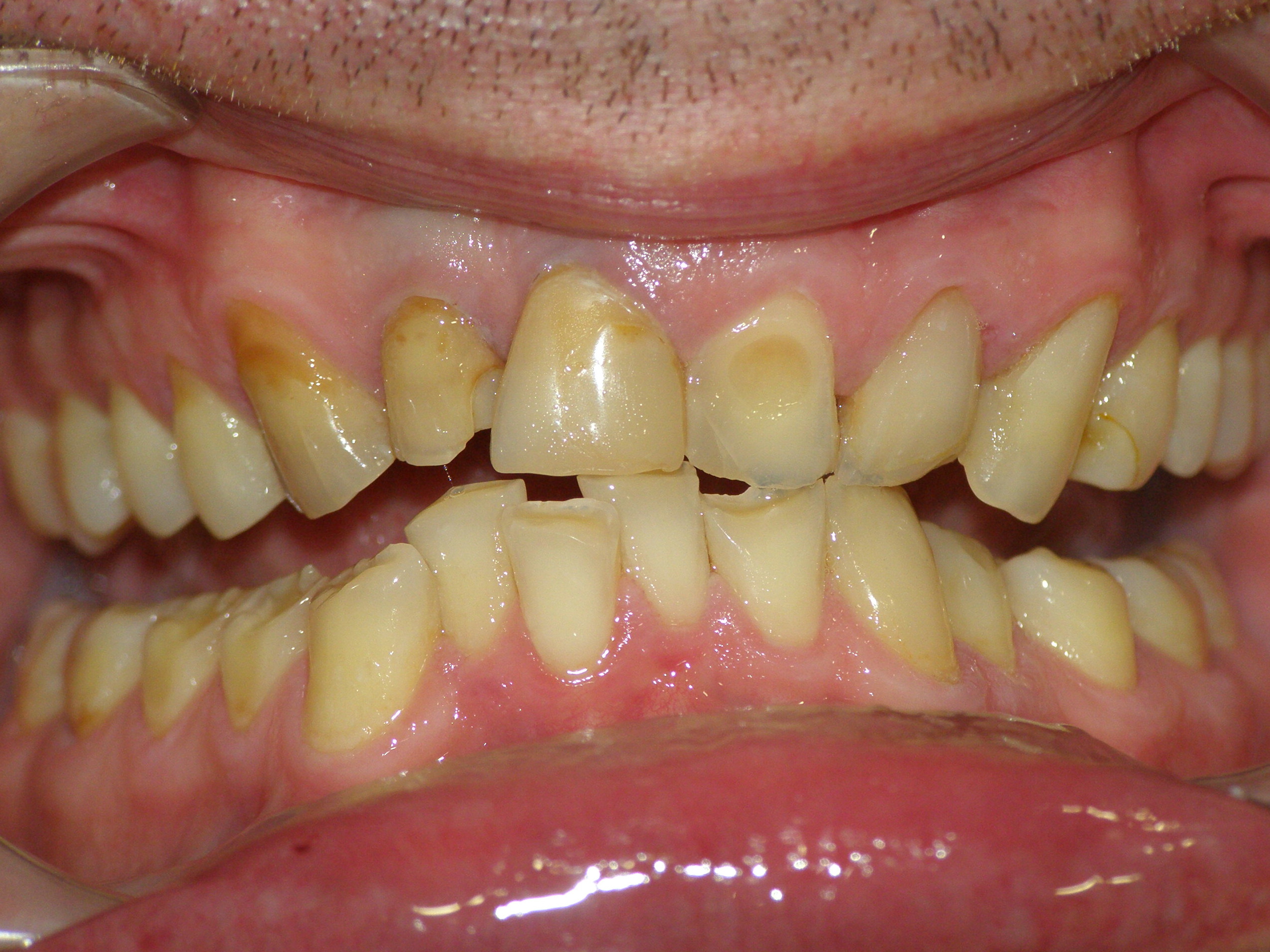 Исправление прикуса брекетами