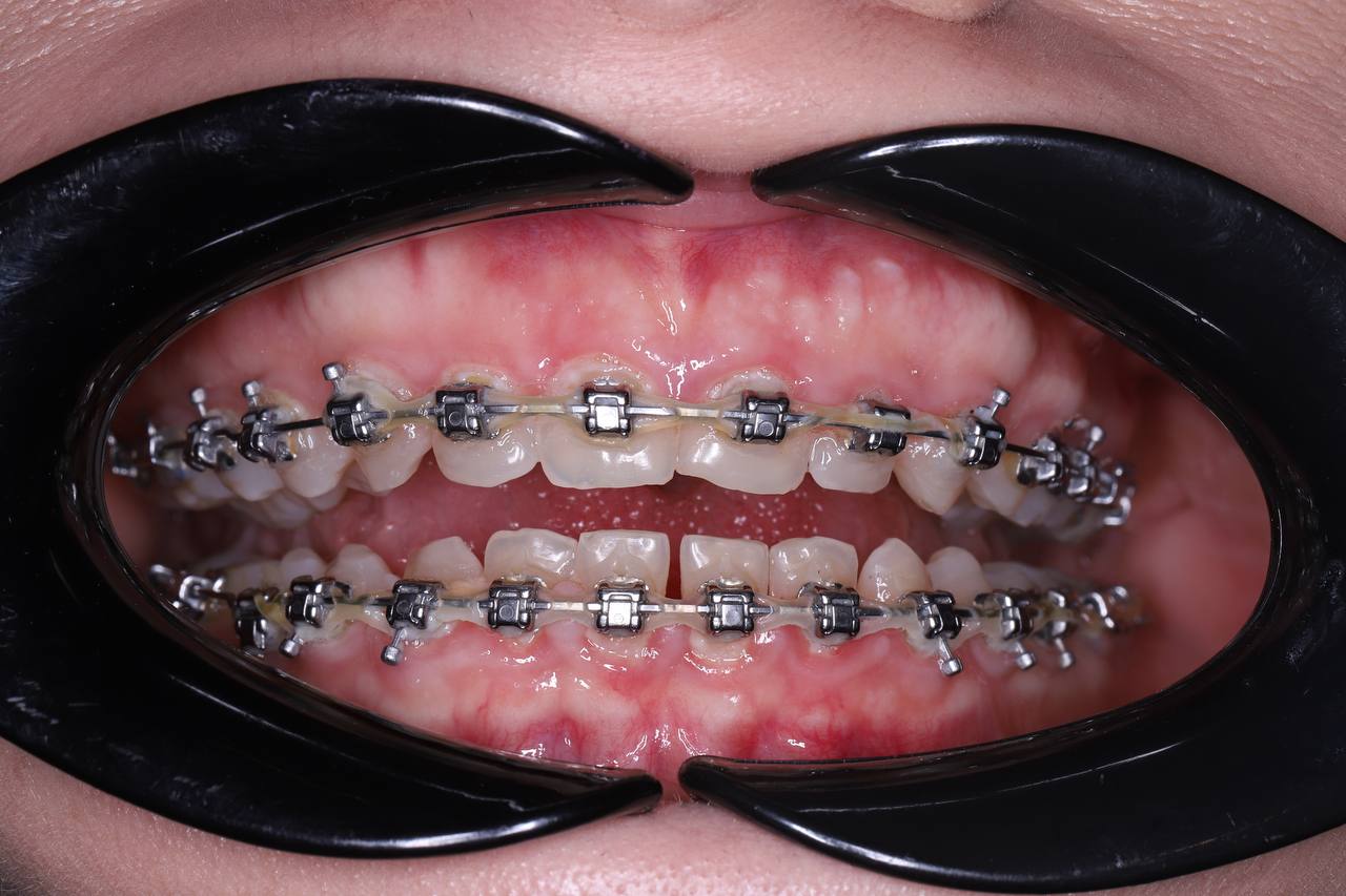 Удлинение клинической коронки зуба