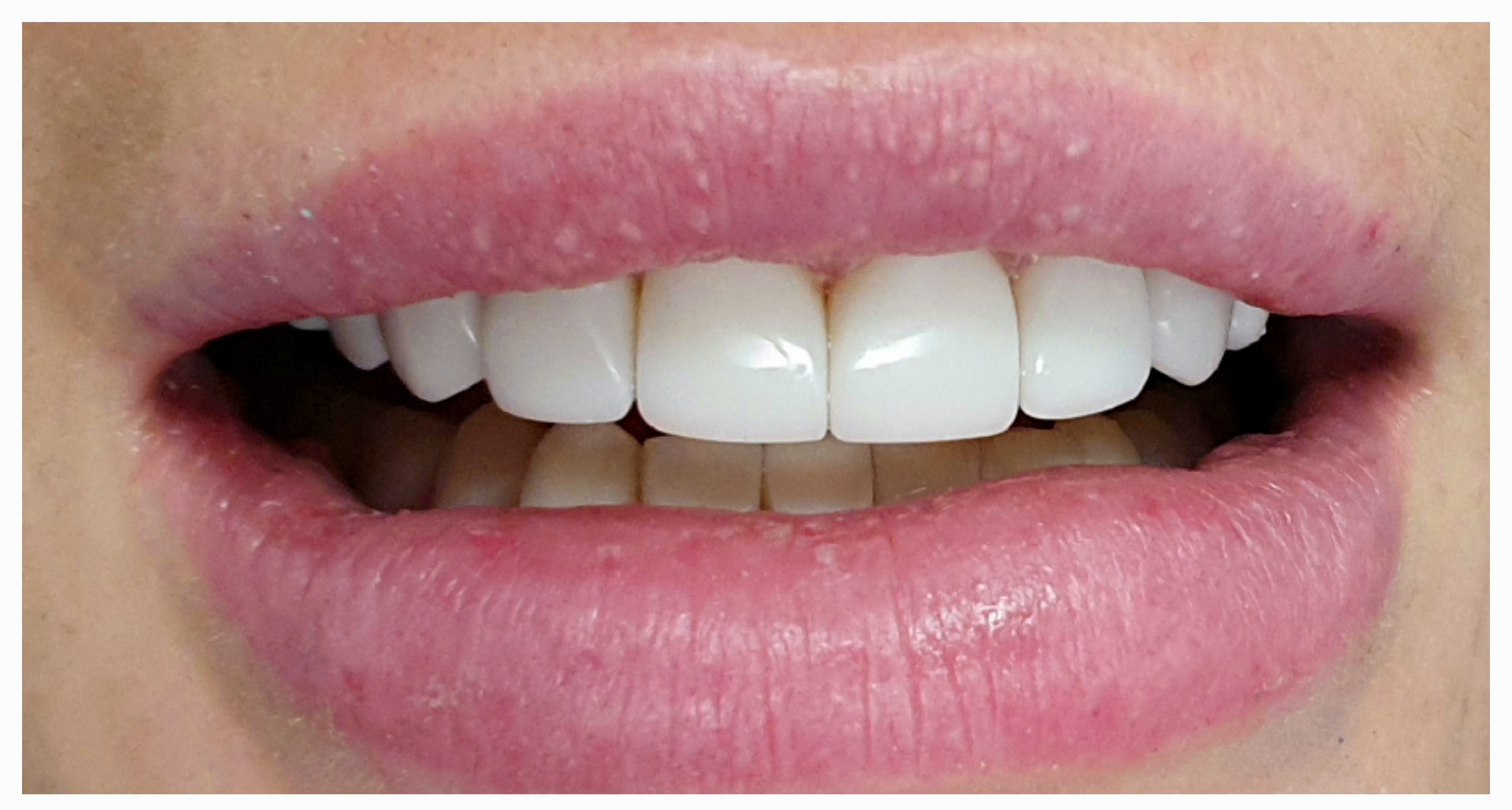 Композитные виниры