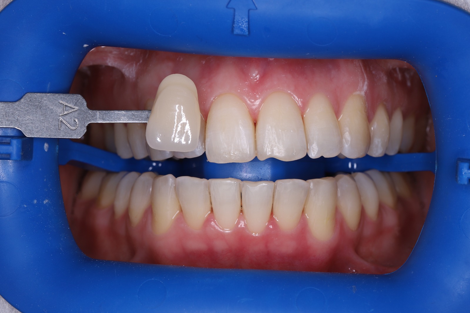 Отбеливание Zoom 4