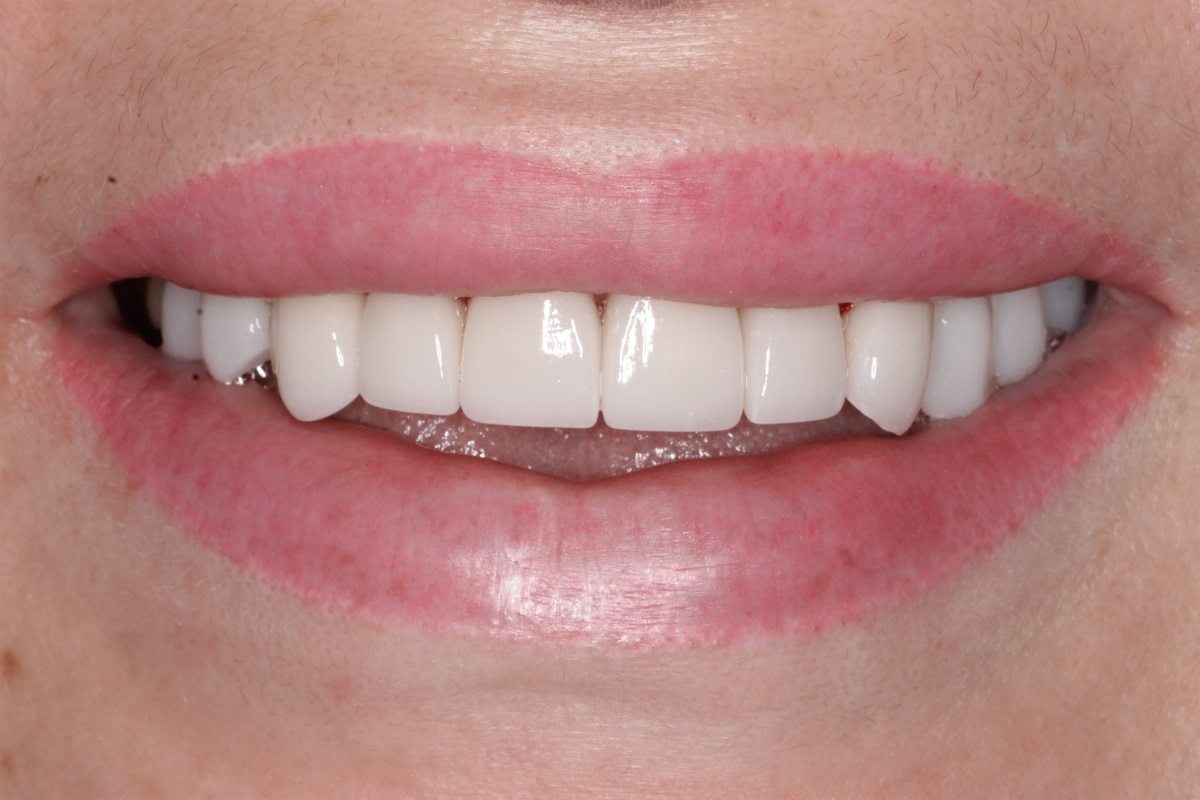 Керамические виниры