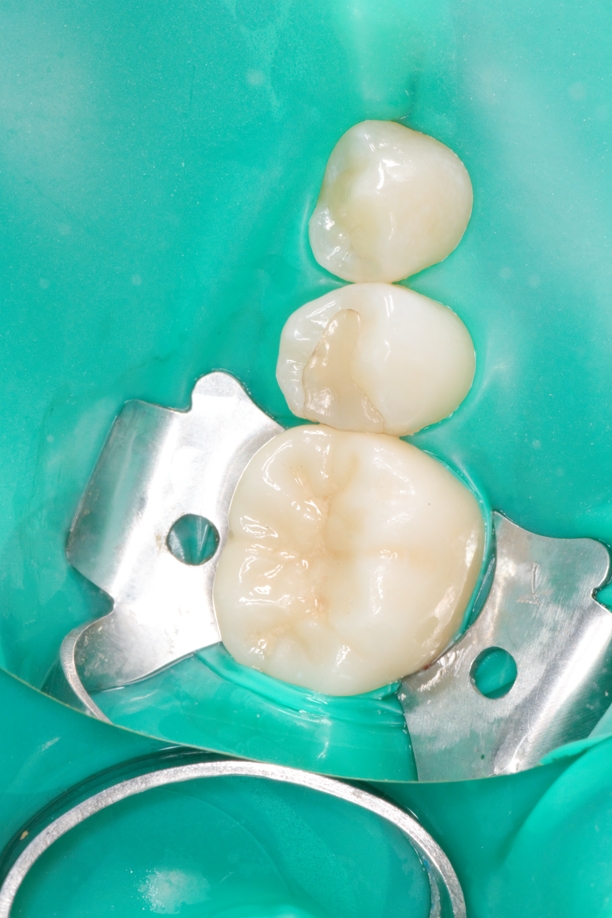 Лечение кариеса