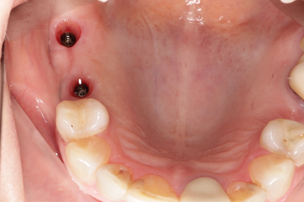 Имплантация зубов