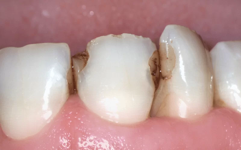 Лечение кариеса между жевательными или передними зубами