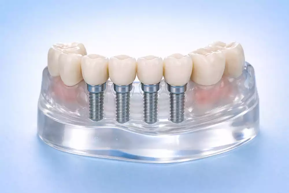 Протезирование зубов — современные методики