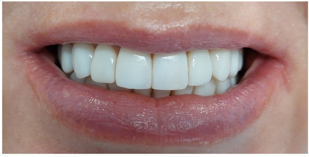 Композитные виниры