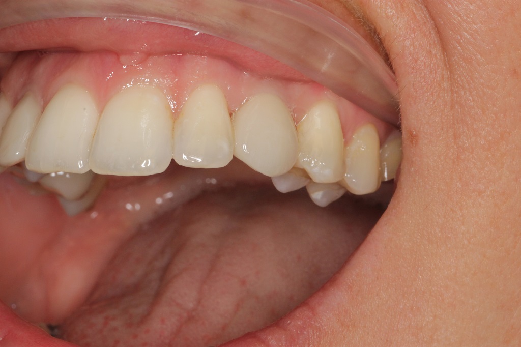 Установка имплантата