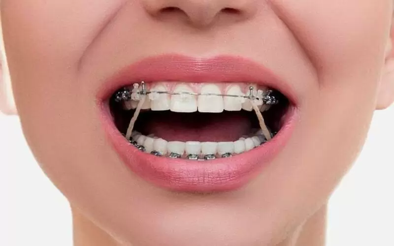 Как убрать щель между зубами