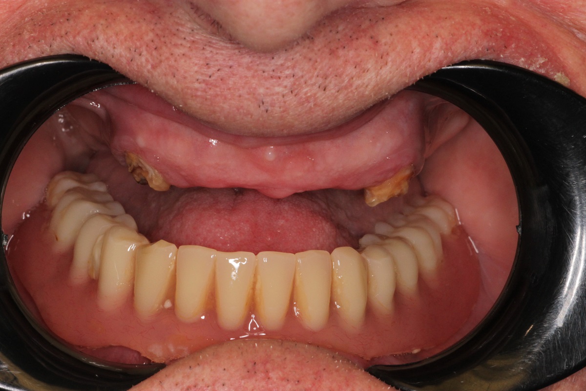 Восстановление верхней и нижней челюсти по системе All-on-6