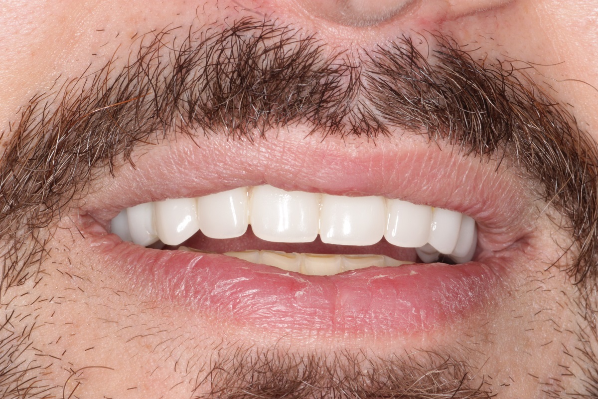 Восстановление верхней челюсти по системе All-on-6