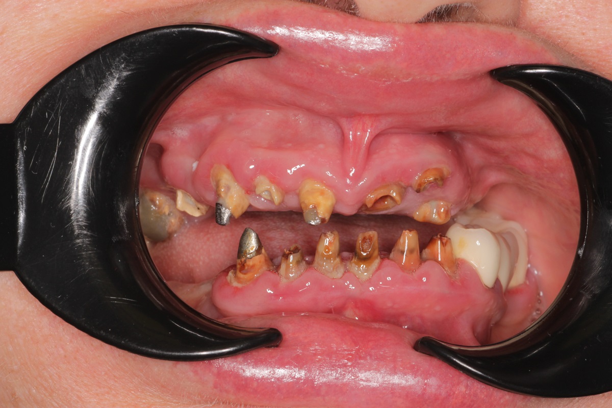 Восстановление верхней и нижней челюсти по системе All-on-6