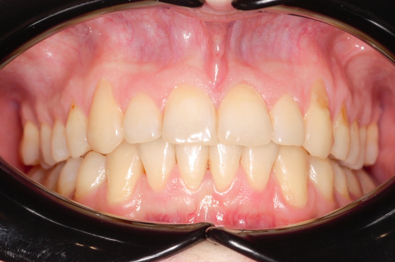 Исправление прикуса брекетами