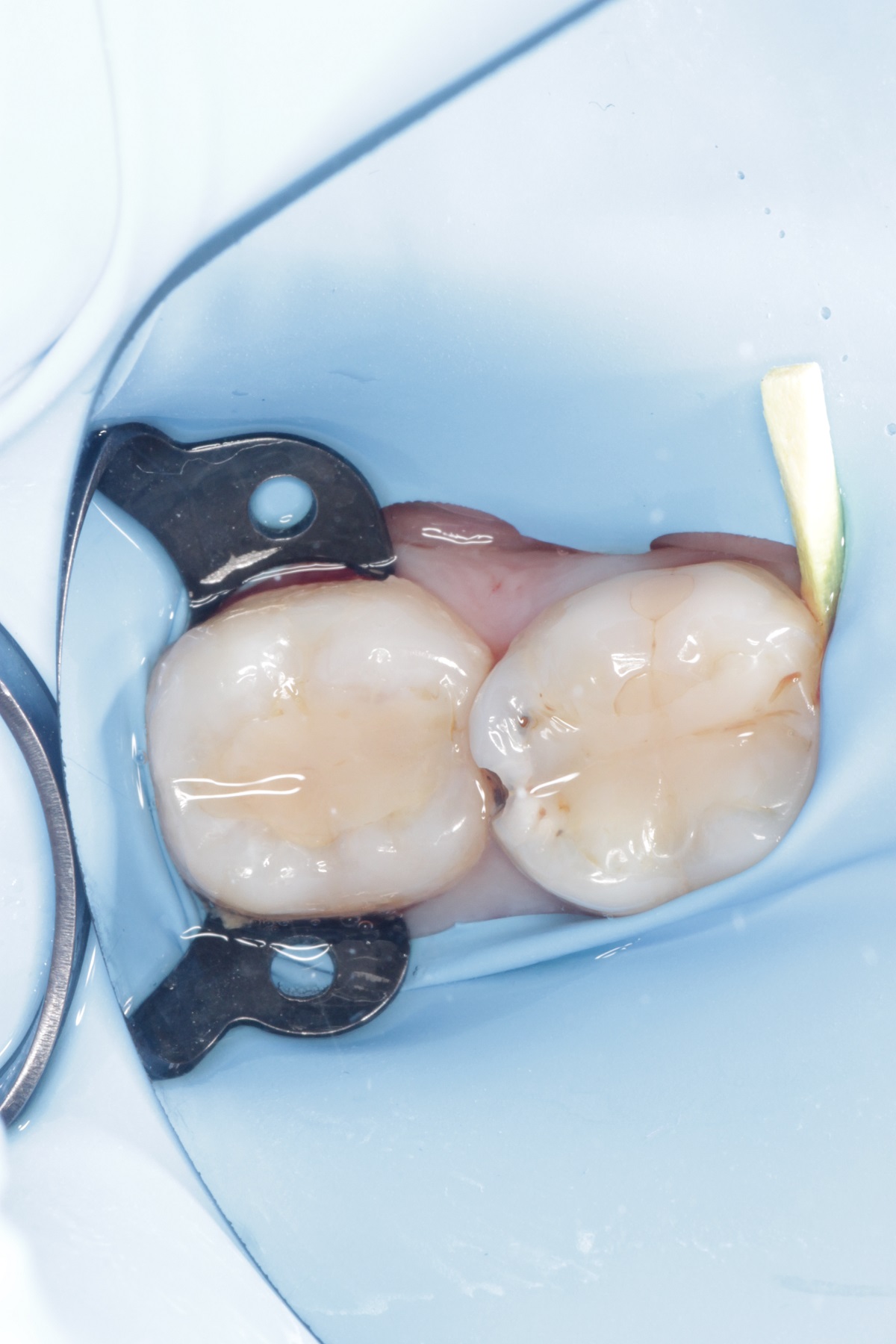 Лечение кариеса