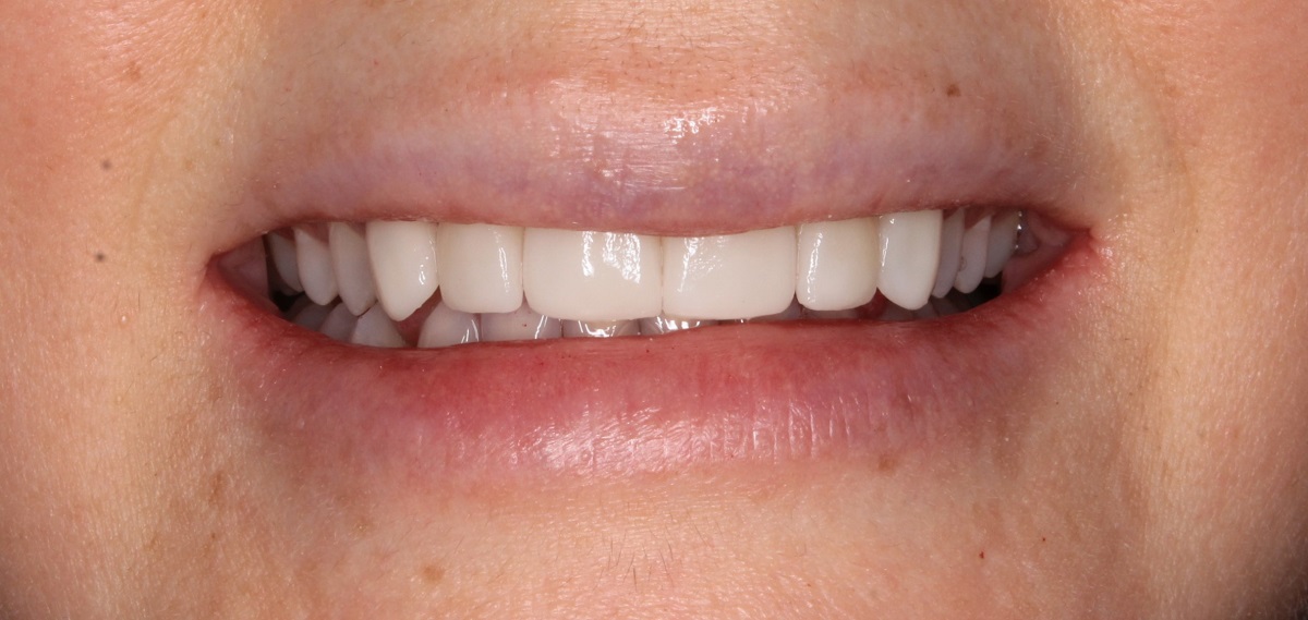 Керамические виниры