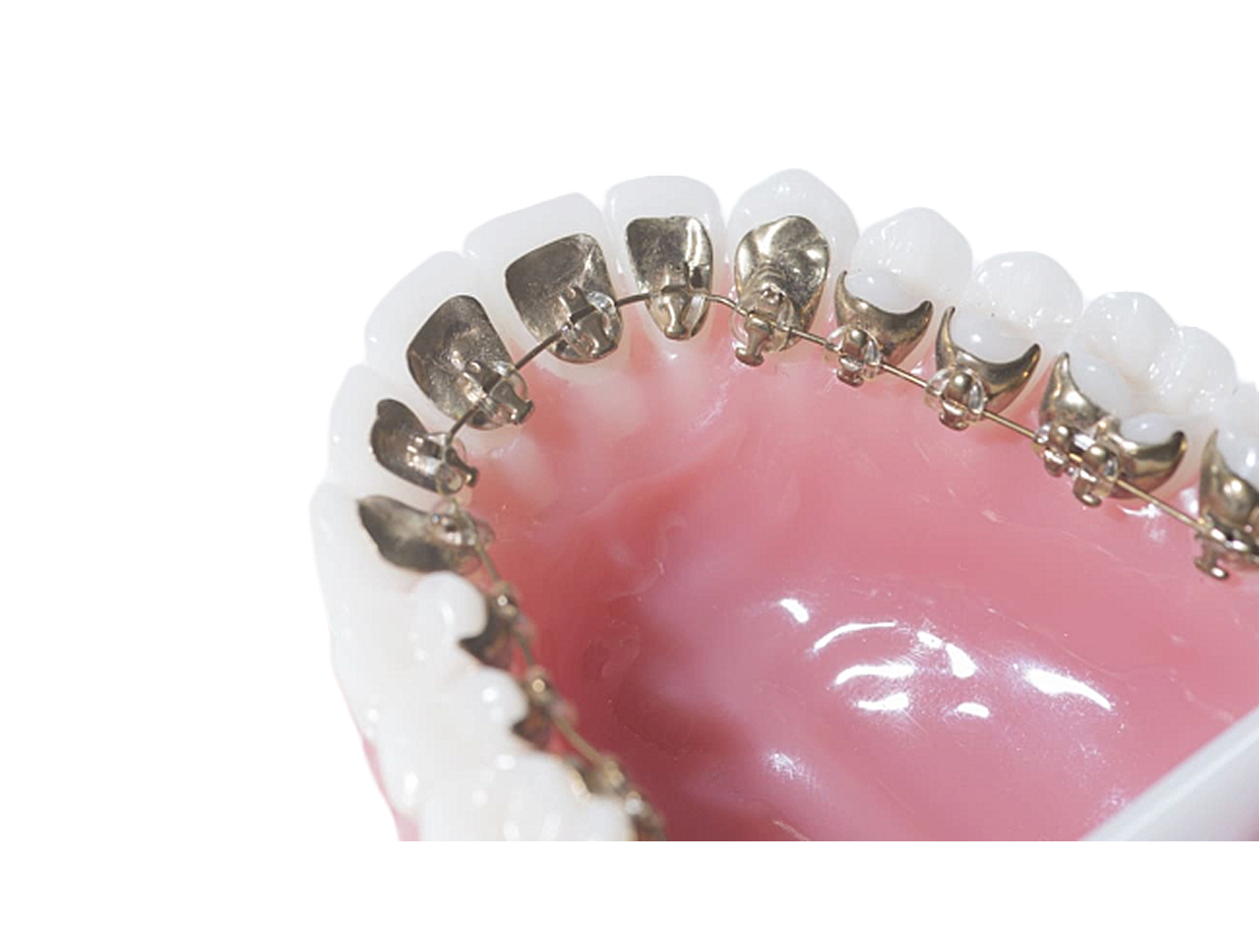 Лингвальные брекеты