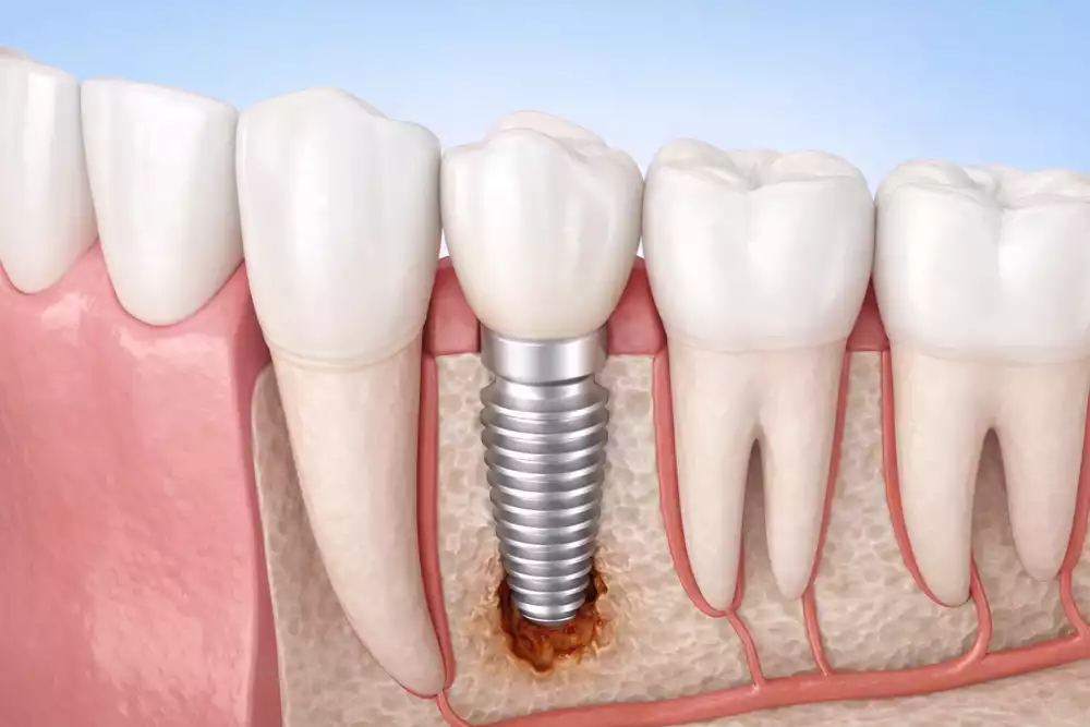 Отторжение импланта зуба – симптомы, признаки, причины, как происходит