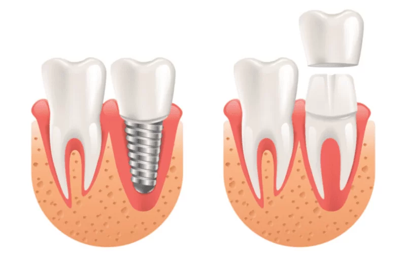 Коронка или имплант - что лучше поставить на зуб