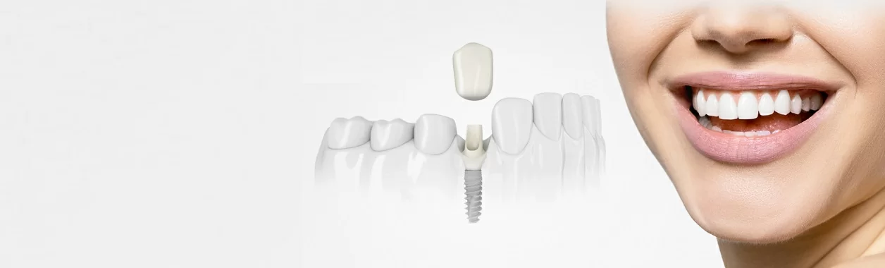 Одноэтапный протокол имплантации