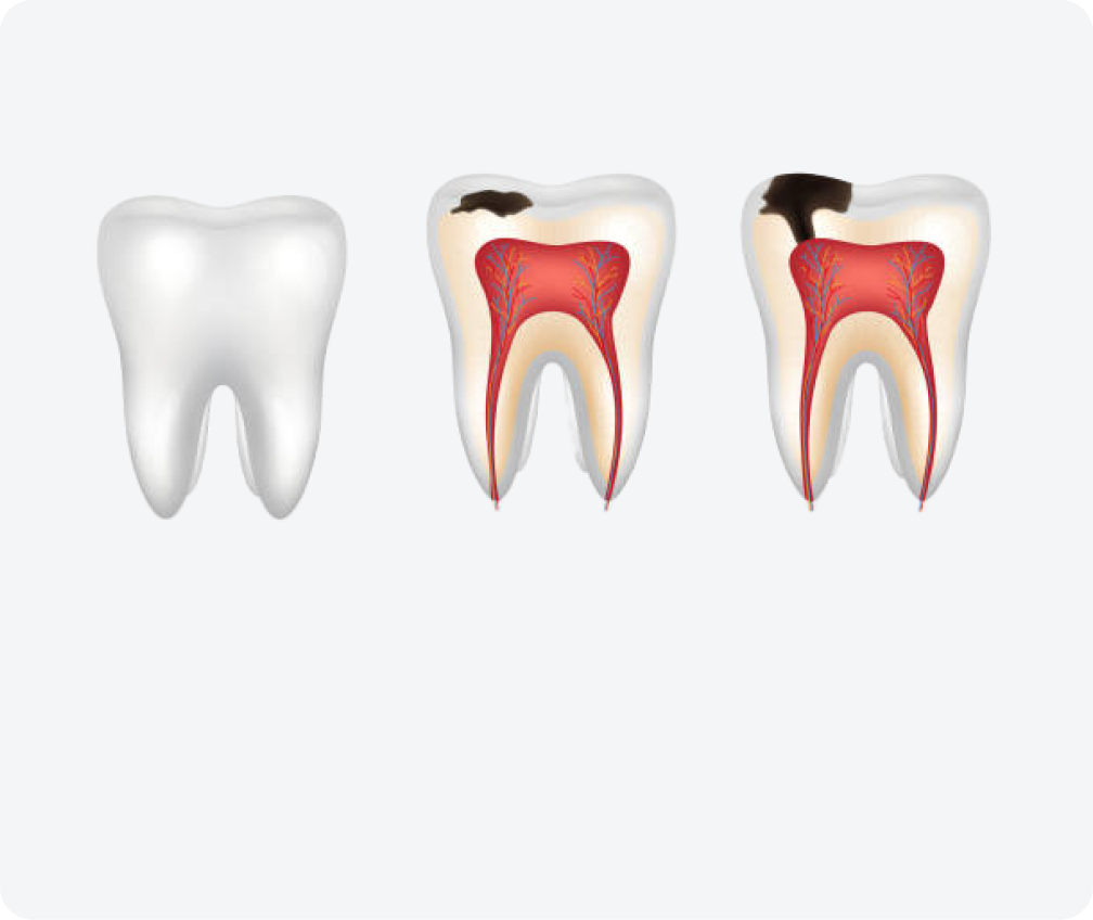 Пломбирование зуба