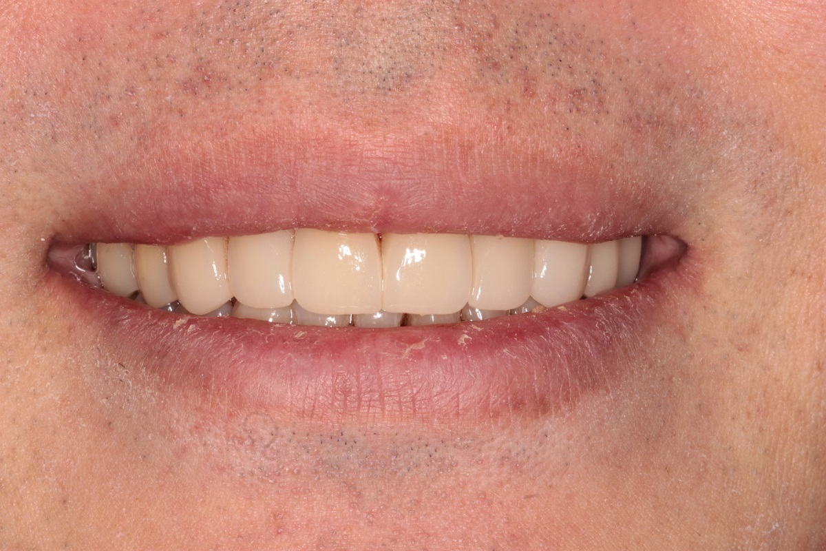 Керамические виниры