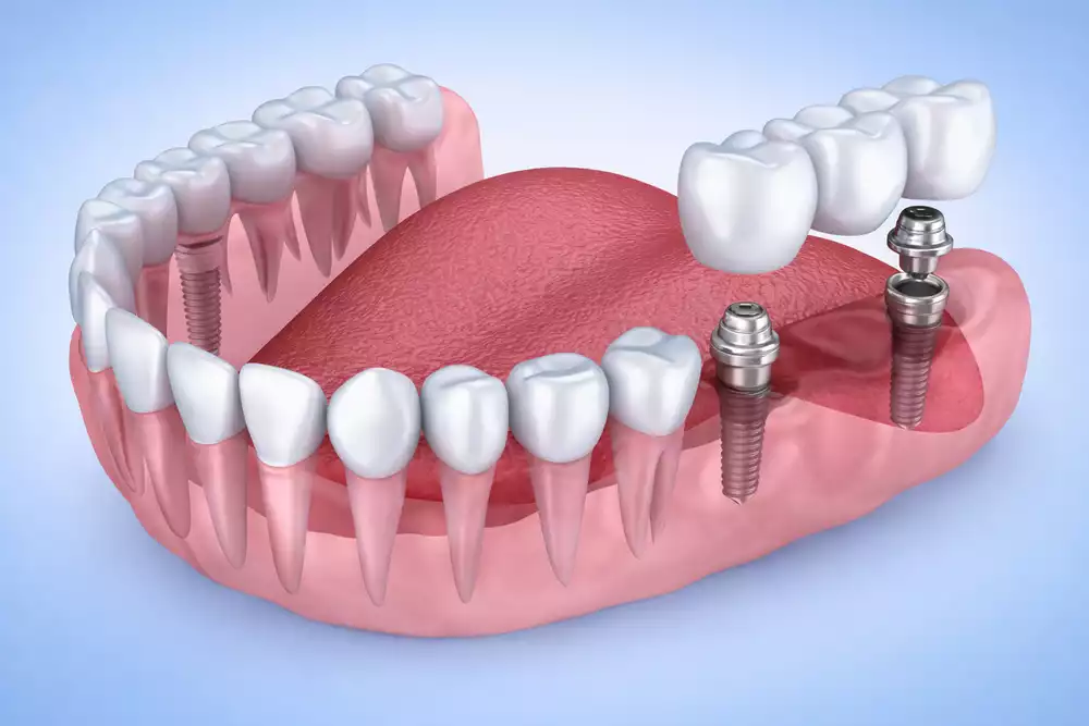 Зубные протезы на имплантах — виды конструкций, преимущества и сроки приживления