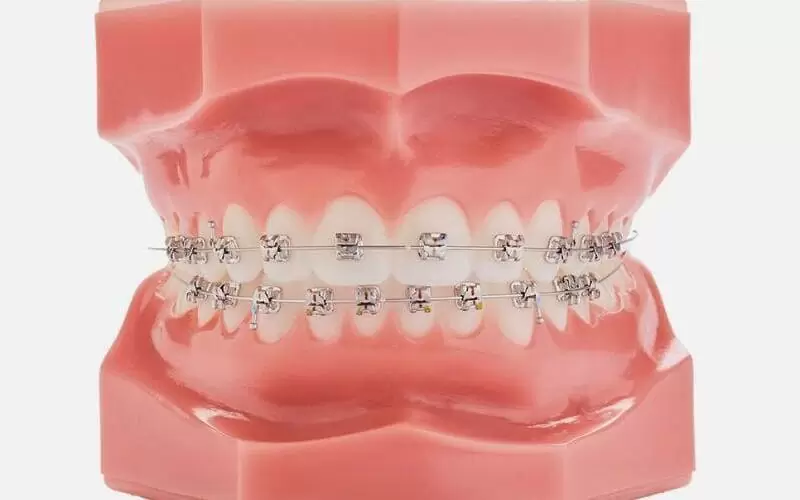 Сколько носят брекеты взрослые и дети