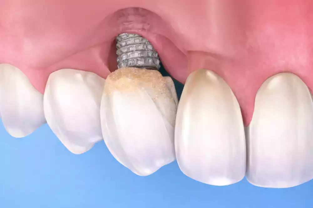 Периимплантит: причины воспаления вокруг импланта и методы лечения