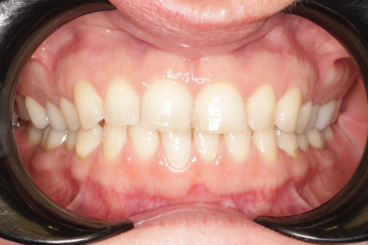 Керамические виниры